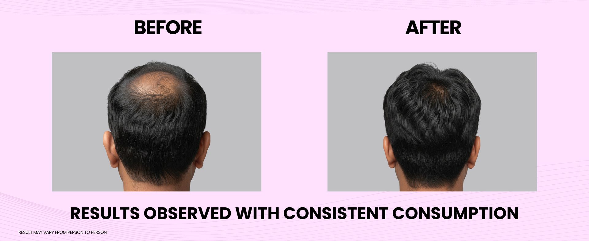 Carbamide Forte Biotin Tablets for Hair Growth | Biotin Supplement 10000 mcg | Hair Supplements for Women & Men | 90 Hair Growth Tablets - 3 Months Supply