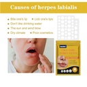 joanofarc-cold-sore-honey-patches-fast-r-5.jpg