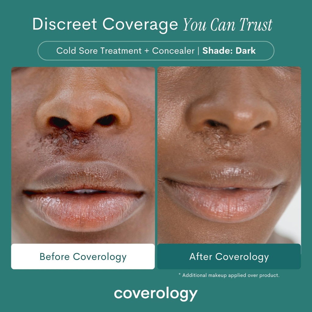 coverology-cold-sore-treatment-cold-sore-3.jpg