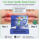 fast-acting-cold-sore-sore-treatment-for-3.jpg