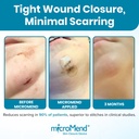 emergency-wound-closure-kit-6-sterile-la-5.jpg