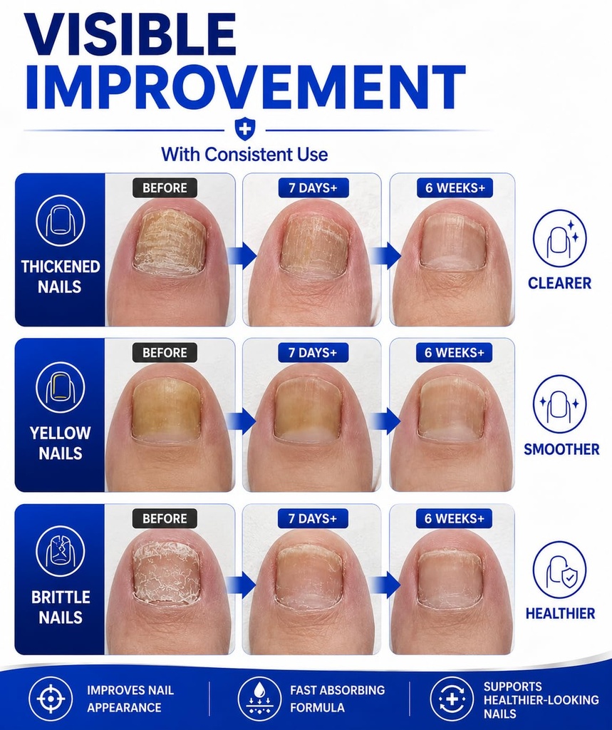 toenail-fungus-treatment-25-undecylenic--71P1yjjYYEL.jpg