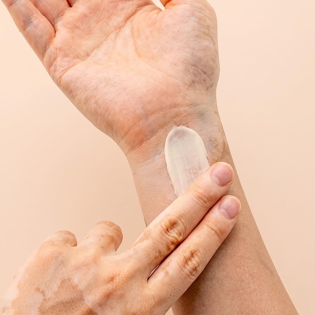 siya-ayurveda-vitiligo-white-spot-care-c-61rYrwX+SmL.jpg