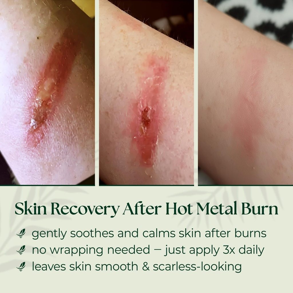 natural-wound-care-burn-gel-first-aid-fo-8110veHtivL.jpg