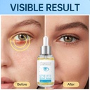 lapersonal-stye-eye-treatment-chalazion--4.jpg