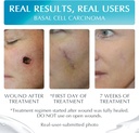 newgel-plus-scar-gel-by-mynewgel-advance-3.jpg