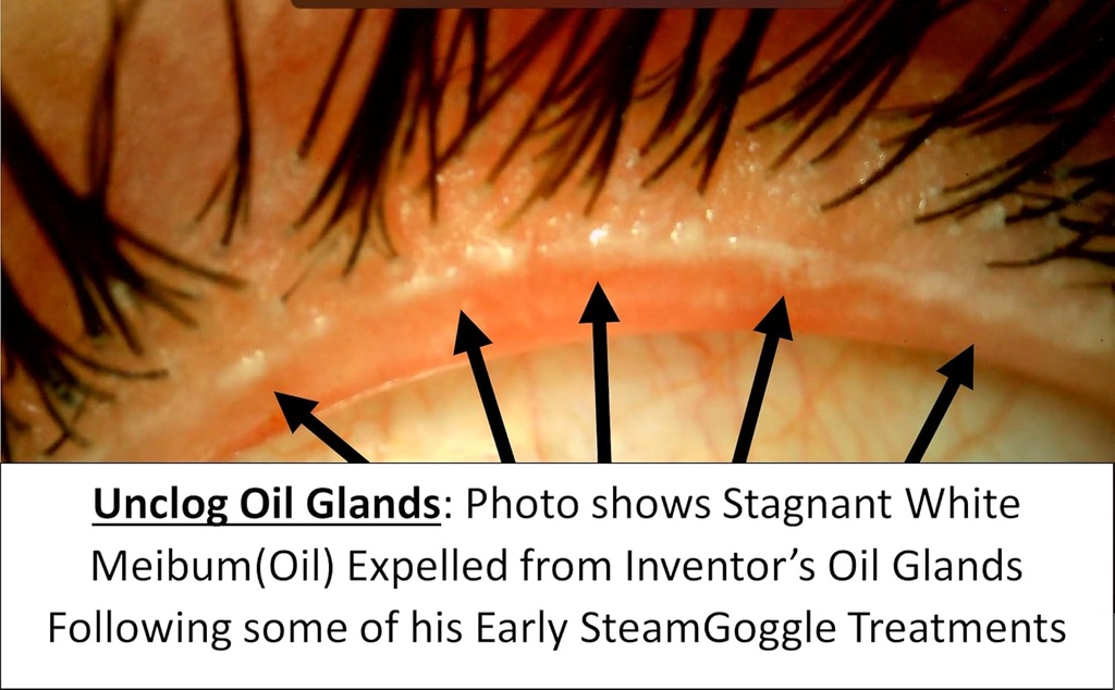 SteamGoggle-Powerful New Dry Eye/Stye Treatment, View Phone/TV During Moist Heat Treatment, Effectively Unclogs Oil Glands for Relief from MGD/Blepharitis/Styes/Chalazions/Irritated Eyes 5
