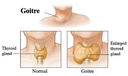 goiterx-goiters-nodules-potent-natural-r-4.jpg